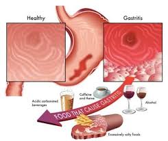 gastritis symptoms and treatment