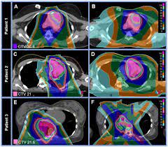 vital organ sparing with proton therapy