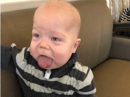Most common clinical finding 4 otic dysplasia ref. A 16 Month Old Has Beckwith Wiedemann Syndrome Which Makes His Tongue Double In Size
