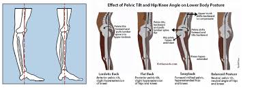 How do you heal up a hyperextended knee? answered by dr. The Knee The Stupid Joint Ellie Herman Pilates