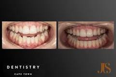 Image result for How Much Does Invisalign Cost In South Africa
