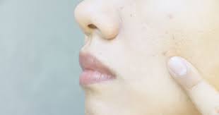 clogged enlarged pores causes