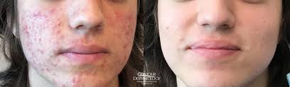 treatment for acne isotretinoin