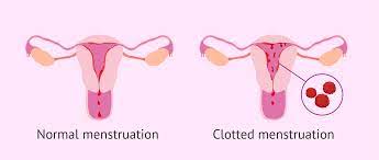 blood clots occur during menstruation