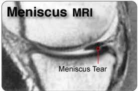 complex meniscus tears