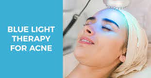 Everything You Need To Know About Blue Light Therapy For Acne