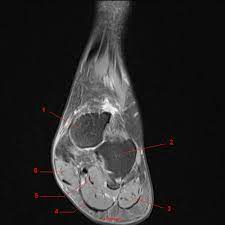 In magnetic resonance imaging (mri) of the elbow, patients are imaged in the supine position or in the prone position with the arm overhead. Mri Of The Ankle Detailed Anatomy W Radiology