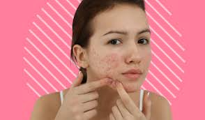 home remes for cystic acne