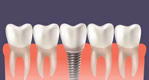 implant dentar cluj ultramodern