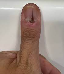 skin cancer in her nail