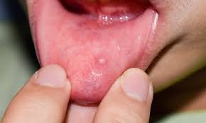 p inside lip symptom causes