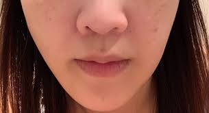 how do i remove lower cheek fat near