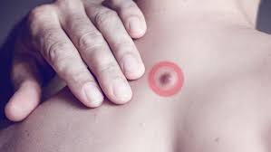 cysts vs skin cancer gentlecure