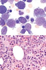Acute Megakaryoblastic Leukemia An Overview Sciencedirect Topics