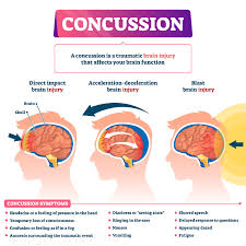 post concussion syndrome