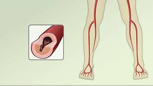 peripheral artery byp leg