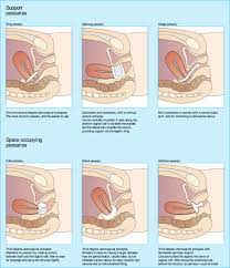 uterine prolapse physiopedia