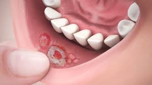 canker sores causes symptoms