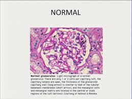 Glomerular Disease Part I Flashcards