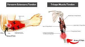 elbow pain during tricep extension