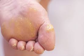 treating plantar warts finding