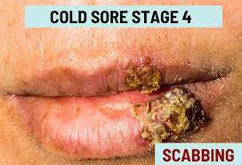 cold sore ses with pictures