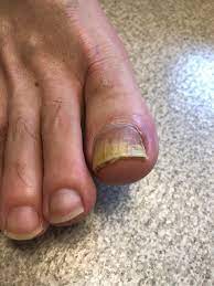 yellow brittle toenails in a man