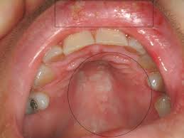 Mediziner bezeichnen die mundfäule auch als stomatitis aphtosa (andere schreibweise: Gingivostomatitis Herpetica Altmeyers Enzyklopadie Fachbereich Dermatologie