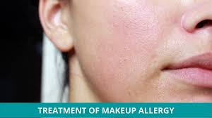 how to treat makeup allergy naturally
