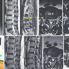 preoperative magnetic resonance images