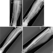 expandable intramedullary nails in