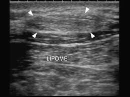 tumours and pseudotumours of the soft