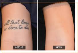 permanent tattoo removal in gurgaon