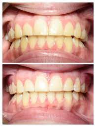 teeth whitening western dental hygiene