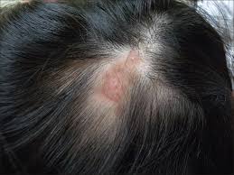 scalp discoid lupus erythematosus