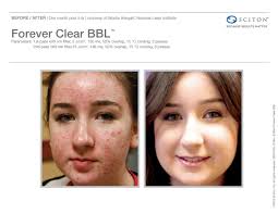 forever clear acne treatment st louis