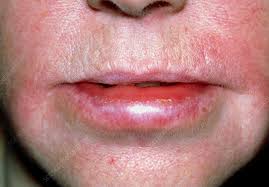 lips due to an allergic reaction