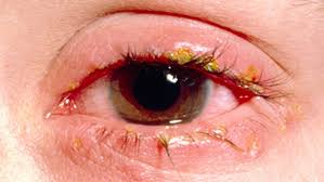eye infections in baby children