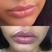 lip filler experience with beauty fix