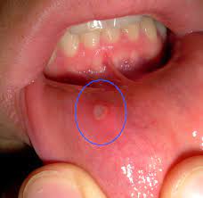 canker sores causes and prevention