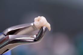 A fixed bridge replaces one or more teeth by placing crowns on the teeth on either side of the space create models, wax forms, and/or plastic patterns in the exact shape and position of the denture to be made. Consent Forms Antoine Dental Center