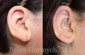 earlobe repair cost in cleveland ohio