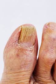 what does toenail fungus look like