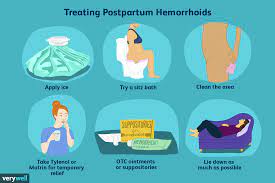 postpartum hemorrhoids symptoms