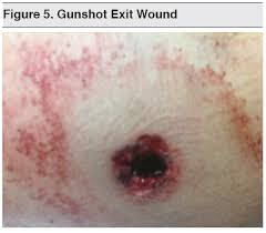 The history of gunshot wounds necessarily parallels that of the. Gunshot Wounds Ballistic Trauma In The Emergency Department