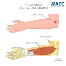 elbow pain types and treatments acc