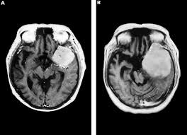 La dbs o deep brain stimolation consiste nella stimolazione di alcuni nuclei profondi a. Meningioma Sintomi Cause Diagnosi E Cure Informazioni Mediche