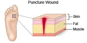 puncture wound what you need to know