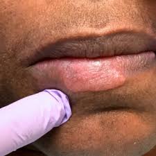 lower lip lesion pink plaque like