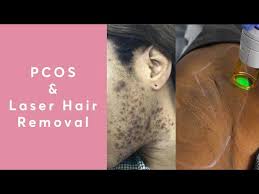Yag 1064 nm and alexandrite 755 nm) to provide effective hair removal for a variety of patients with different hair types and skin tones. Does Laser Hair Removal Work For Pcos Youtube